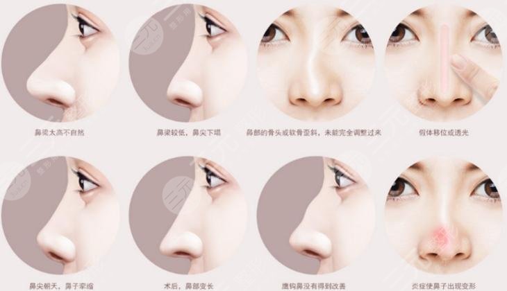 鼻子修復(fù)必須要滿3個(gè)月嗎？二次鼻整形術(shù)前指南！小白必看~