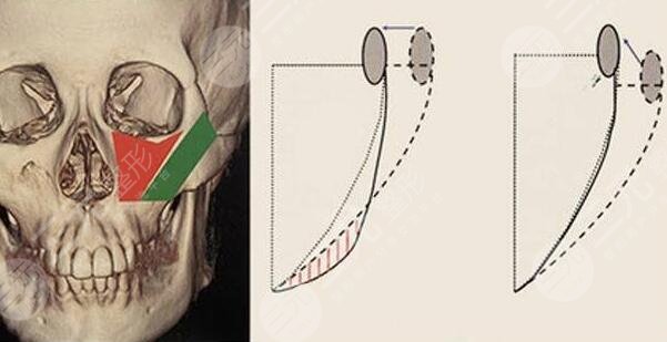 磨顴骨有風(fēng)險嗎？