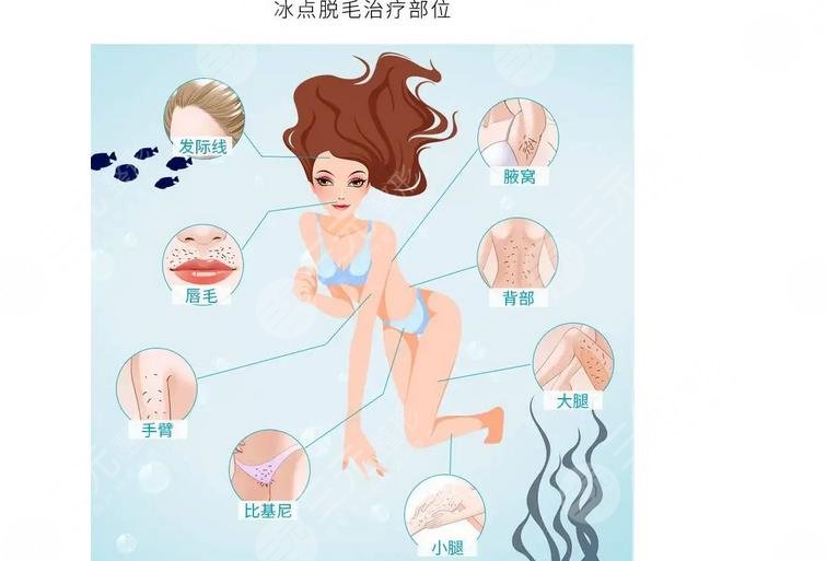 冰點(diǎn)脫毛