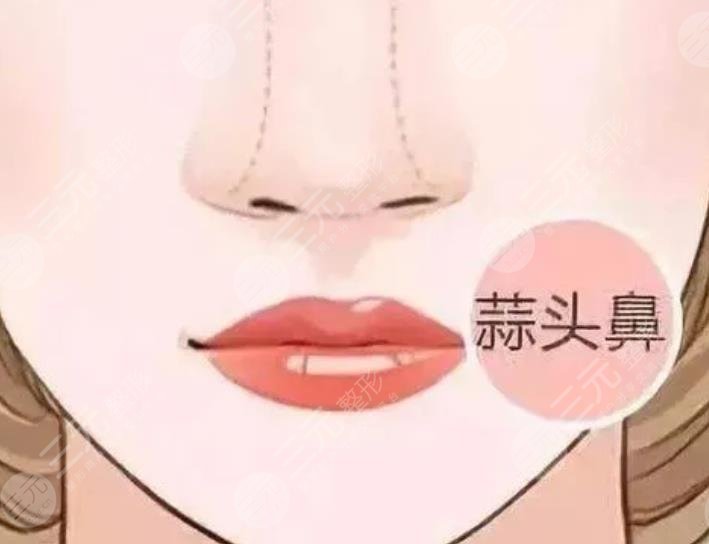 蒜頭鼻縮小手術多少錢