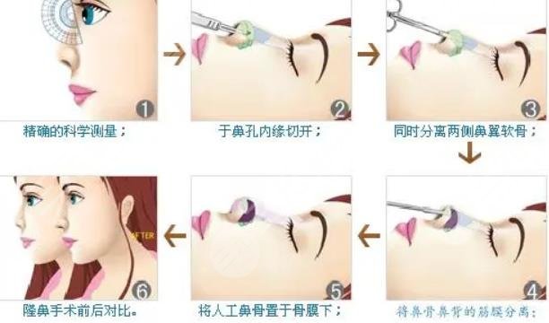 自體軟骨隆鼻有哪些優(yōu)缺點