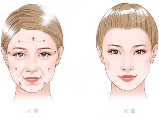 拉皮適合多大年齡女性