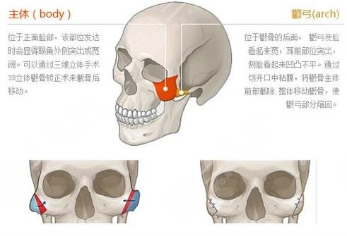 磨顴骨手術(shù)有什么風(fēng)險(xiǎn)和后遺癥