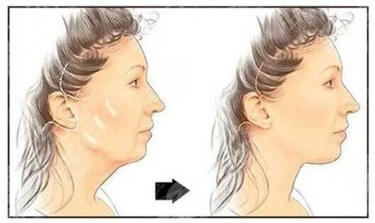 自身因素影響了冰電波拉皮的價格