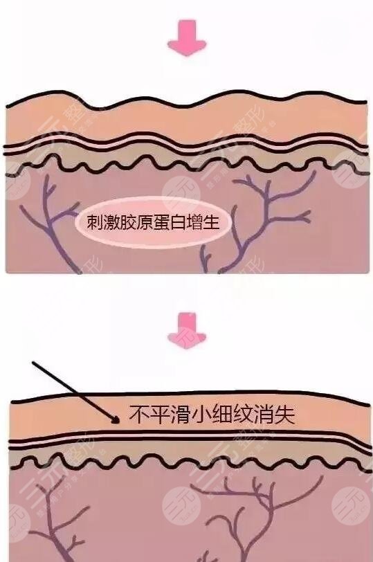 不同的操作員影響力冰電波拉皮的價格