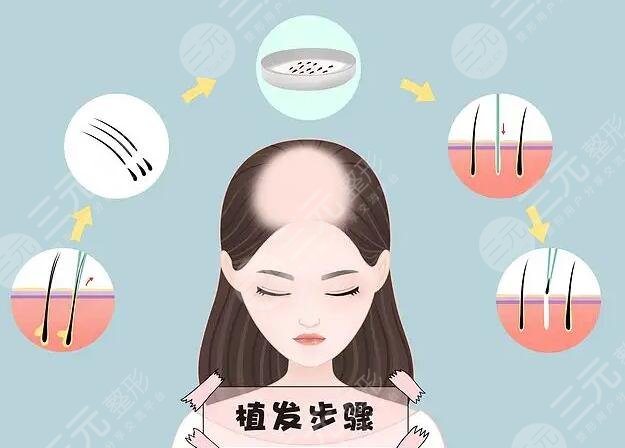 植發(fā)手術(shù)10元20元區(qū)別大嗎?