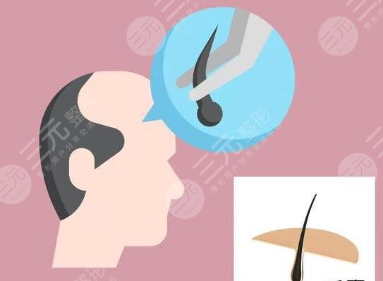 植發(fā)手術(shù)怎么操作?