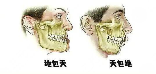 天包地矯正后臉型變化圖共享，矯正前的“如花”，矯正后的“側顏女神”~