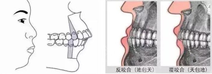 包地矯正后臉型變化圖