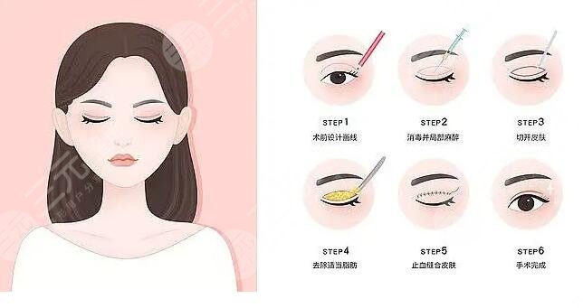 雙眼皮全切七天恢復圖過程細節(jié)記錄！國內(nèi)割雙眼皮醫(yī)院排行榜及價格表深度調查~