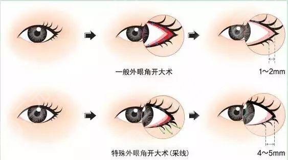 10個(gè)開(kāi)內(nèi)眼角9個(gè)留疤是真的嗎?