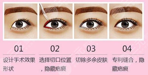 10個(gè)開(kāi)內(nèi)眼角9個(gè)留疤是真的嗎?