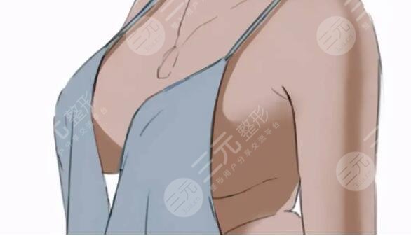 隆胸假體可以放一輩子嗎？擠了會不會變形？一輩子不取出會怎么樣？美胸必看！