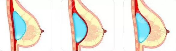 隆胸手術(shù)要多久后才能過正常生活