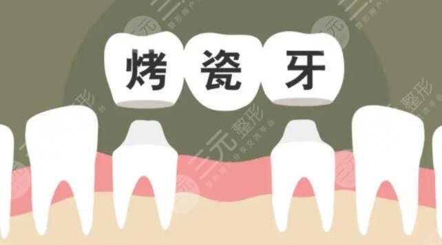 烤瓷牙多少錢一顆價(jià)格表2022全國，烤瓷牙壽命可以保持幾年？收藏不虧！