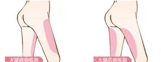 瘦大腿吸脂價(jià)格