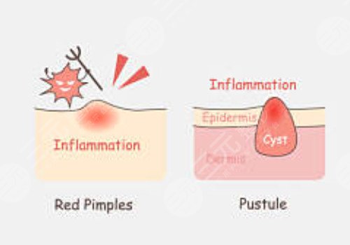 臉上長痘印如何消除?