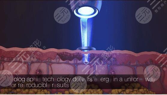 激光美白的價格是多少?