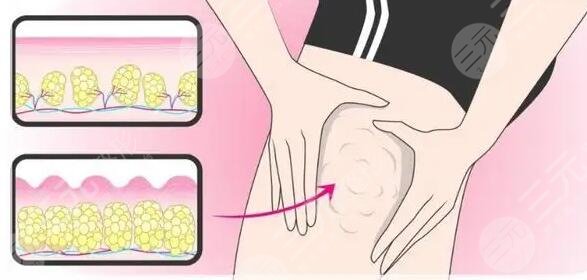 吸脂減肥價(jià)格