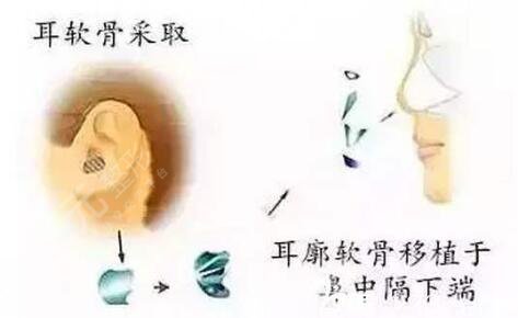 自體軟骨隆鼻果可以維持多久？