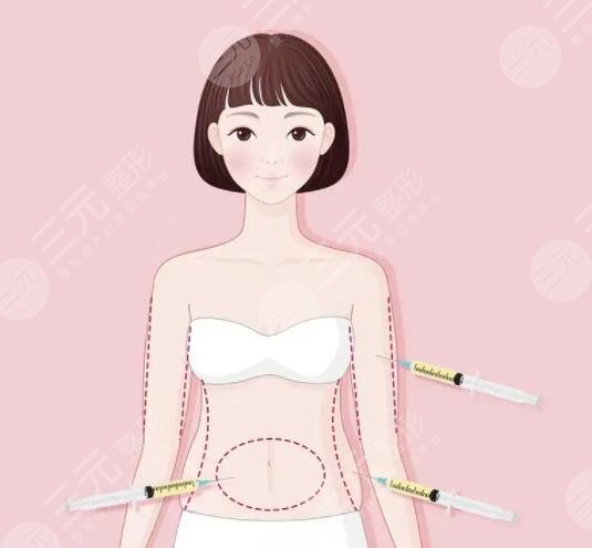 五度吸脂術(shù)的原理是怎樣的？果可以維持多久？技術(shù)優(yōu)勢一一列出你心動嗎？