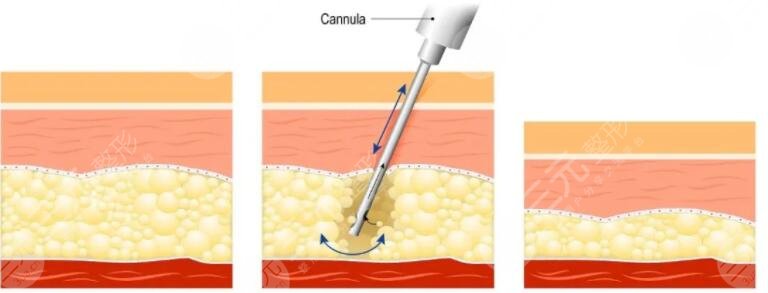 五度吸脂可以維持多長時間？
