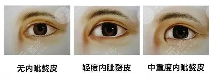 開(kāi)內(nèi)眼角的手術(shù)有哪些?