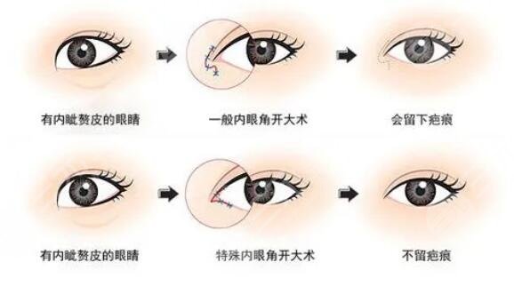 開(kāi)內(nèi)眼角手術(shù)價(jià)格