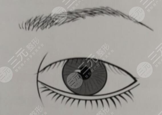 做開(kāi)眼角手術(shù)要注意什么?
