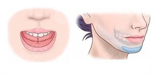 隆下巴假體恢復(fù)過(guò)程圖整理！隆下巴的手術(shù)過(guò)程是怎樣的？注意事項(xiàng)有哪些？