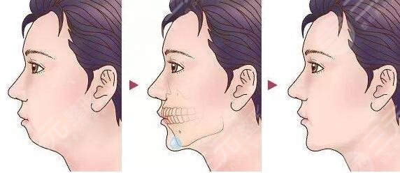 隆下巴假體恢復(fù)過(guò)程圖