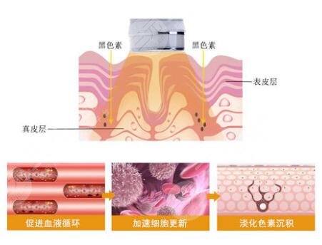 復合彩光去痘幾次有?