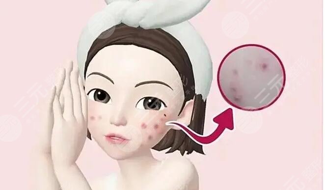 痤瘡疤痕怎么治才能徹底？這幾種有方法網(wǎng)友們親測果，給你更好選擇~