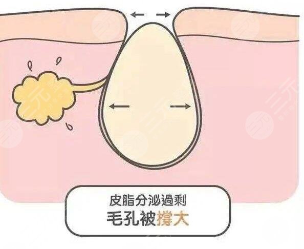 什么醫(yī)美項(xiàng)目收縮毛孔果好？近幾年爆款醫(yī)美項(xiàng)目云集，總有一款適合你~