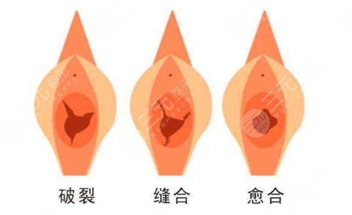 收緊陰道時的注意事項有哪些