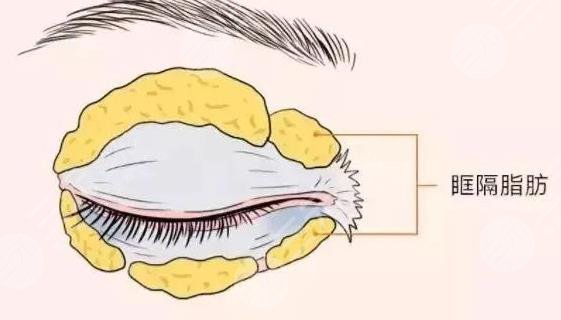 腫眼泡吸脂一般價(jià)位是多少?