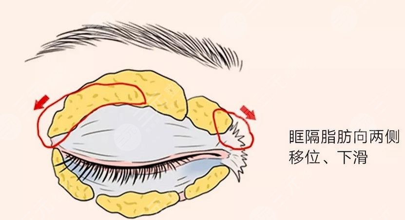 腫眼泡吸脂一般價(jià)位是多少?