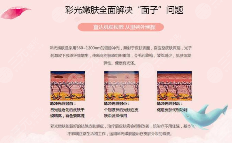 復合彩光緩解多少錢？