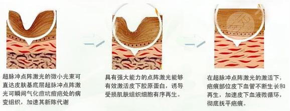 光子去痘有用嗎?原?理介紹