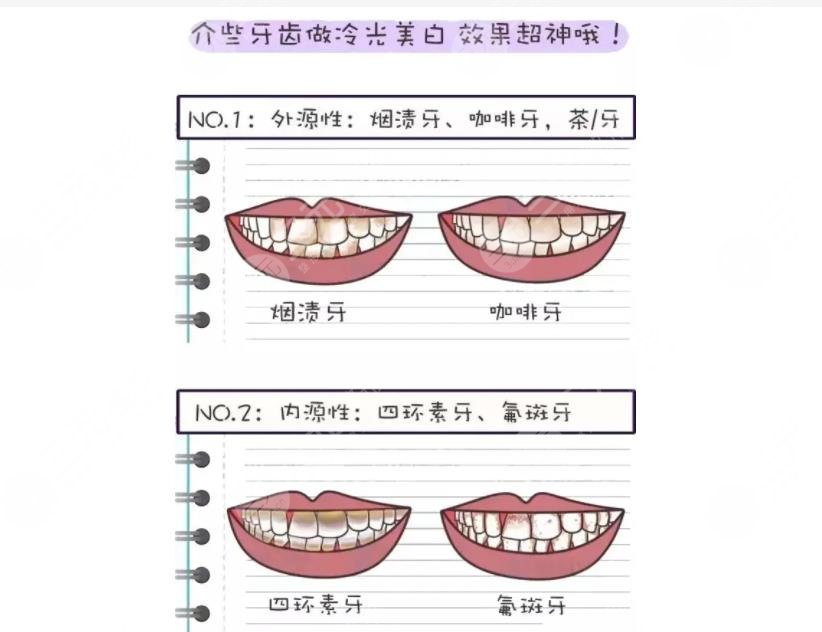 超聲波潔牙可靠嗎？