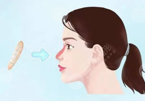 硅膠假體隆鼻一般維持多久?