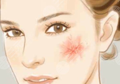 臉蛋紅血絲怎么治?
