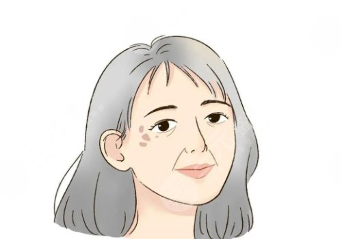 怎樣治老年斑？
