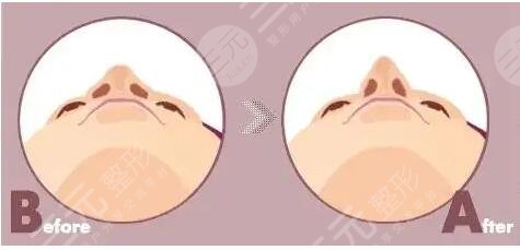 鼻頭鼻翼鼻尖整形恢復(fù)果前后對比