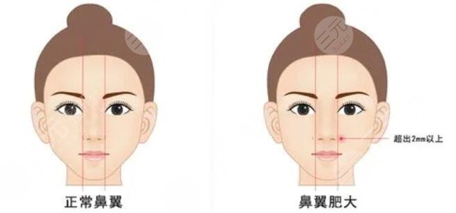 鼻頭鼻翼鼻尖整形的注意事項