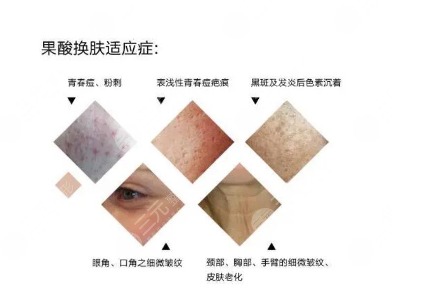 果酸換膚費(fèi)用大概?多少?