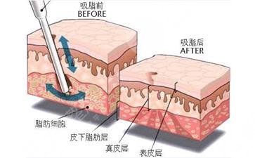 冬季快速減肥的注意事項(xiàng)