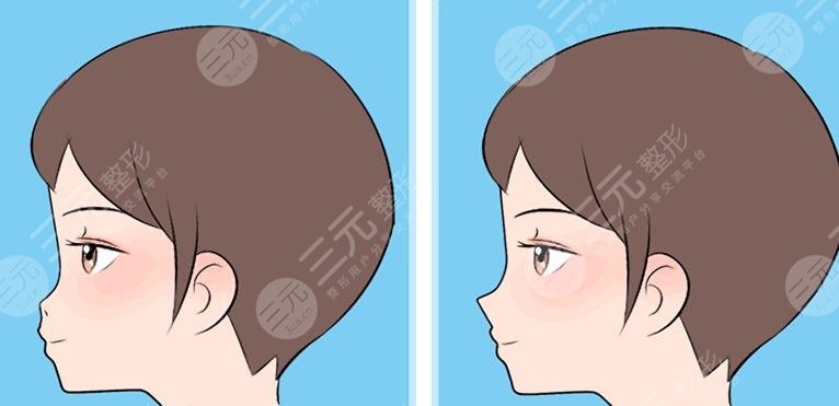 鼻子整形前后對(duì)比圖