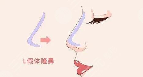 鼻子整形前后對(duì)比圖