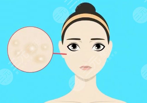 臉部長有脂肪粒是怎么回事？